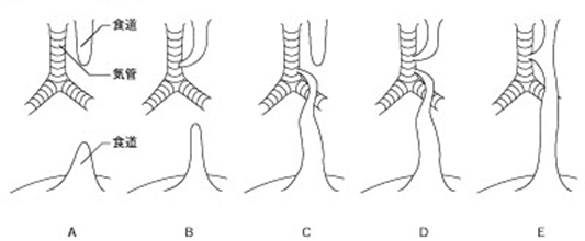 食道閉鎖の代表的病型