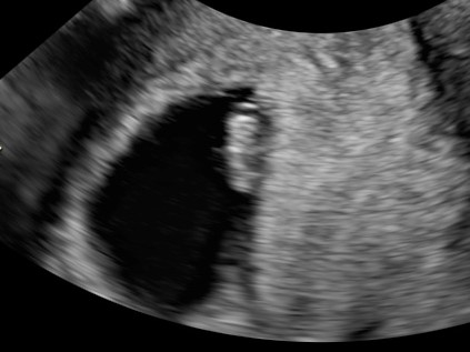 胎嚢 見え 週 ない 5 妊娠5週～7週 胎芽見えない