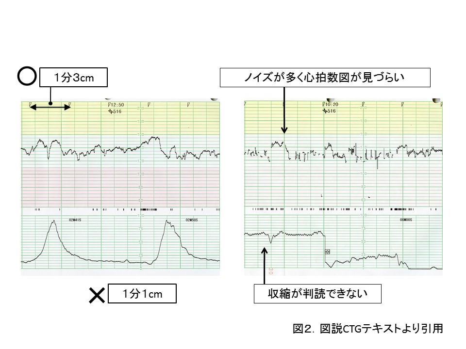 ノン ストレス テスト と は