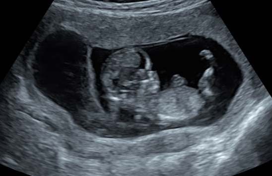 初期 子宮 内出血 妊娠