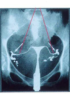 子宮卵管造影1