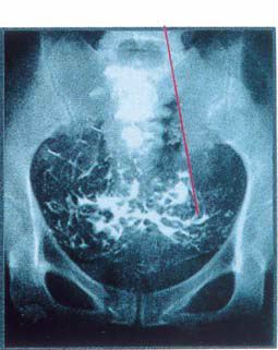 子宮卵管造影3