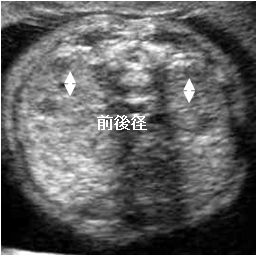 胎児泌尿器系異常 閉塞性尿路疾患 嚢胞性腎奇形など を見つけたら