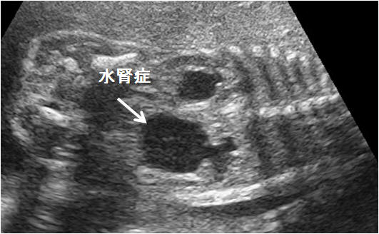 胎児泌尿器系異常 閉塞性尿路疾患 嚢胞性腎奇形など を見つけたら