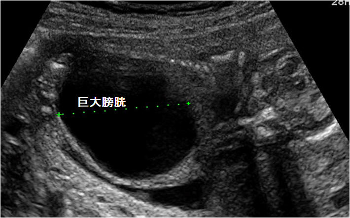 胎児泌尿器系異常 閉塞性尿路疾患 嚢胞性腎奇形など を見つけたら 産科編