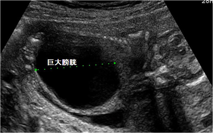 胎児泌尿器系異常 閉塞性尿路疾患 嚢胞性腎奇形など を見つけたら