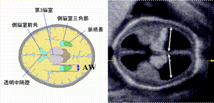 胎児水頭症 出生前診断と妊娠中の対応