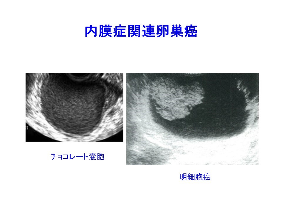 3 チョコレート嚢胞患者を高次医療機関へ紹介するタイミング サイズ エコー輝度 隆起性病変 日本産婦人科医会