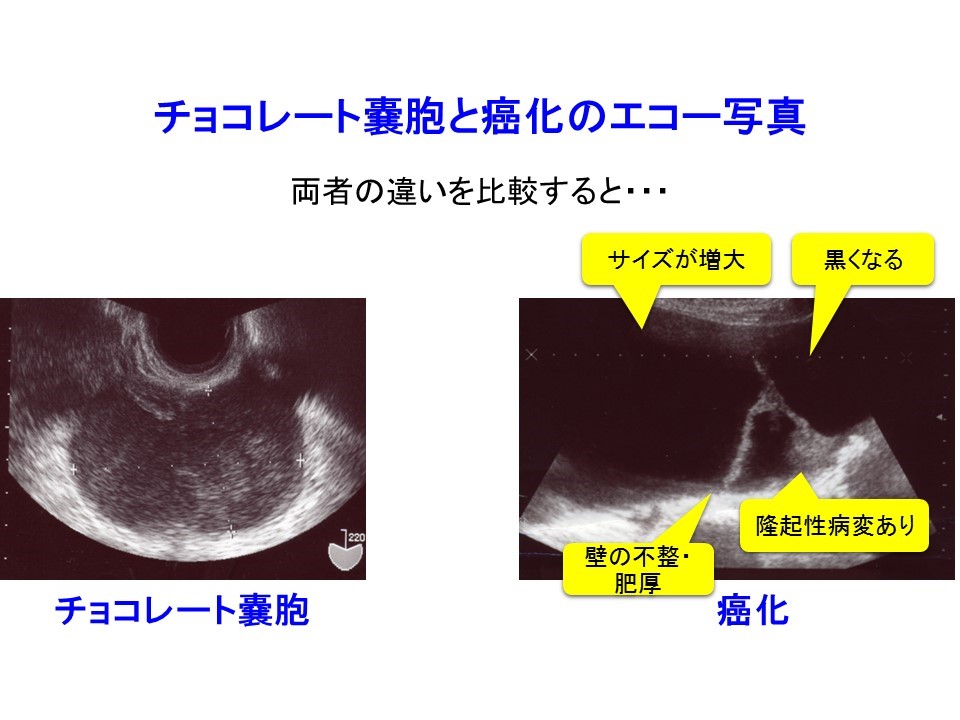 3 チョコレート嚢胞患者を高次医療機関へ紹介するタイミング サイズ エコー輝度 隆起性病変 日本産婦人科医会