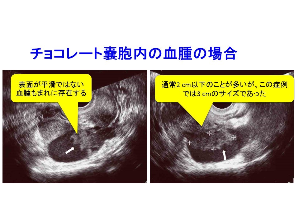 3 チョコレート嚢胞患者を高次医療機関へ紹介するタイミング サイズ エコー輝度 隆起性病変 日本産婦人科医会