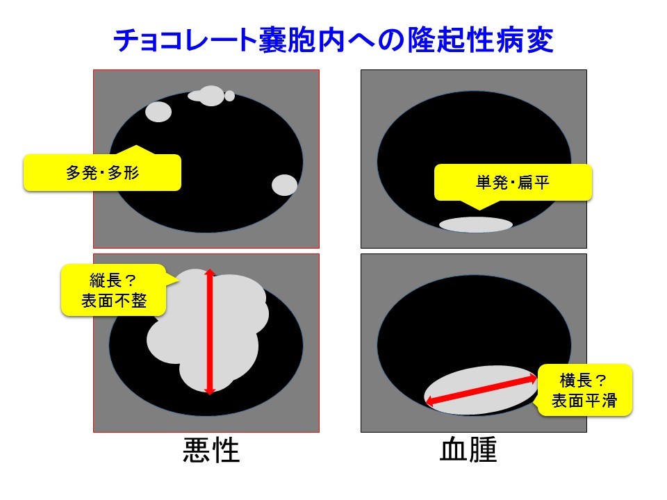 消える チョコレート 嚢胞