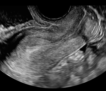 週 のみ 6 胎嚢 妊娠６週目出血、胎嚢のみ。