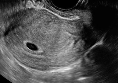 エコー写真 妊娠初期