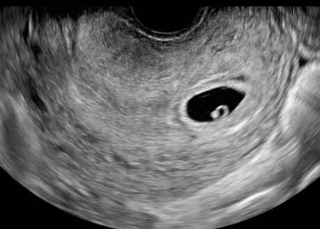 5w6d 胎嚢の大きさは平均14 4mm 妊婦50人を比較