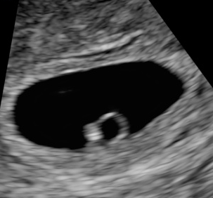 5 胎嚢 さ 週 妊娠 大き 妊娠5週(5w4d)で6.3ミリの胎嚢確認！平均よりも胎嚢サイズ小さい？
