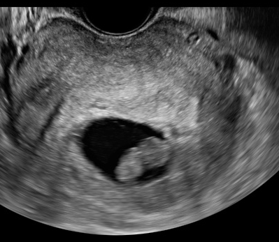 週 ない 5 胎嚢 確率 見え 【2度の流産と妊活記録Vol.1】妊娠5週で胎嚢見えない？異所性妊娠（子宮外妊娠）の危険とは？