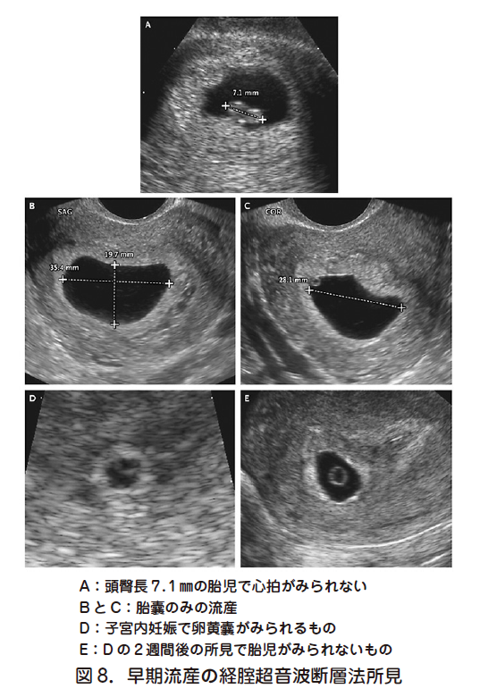 妊娠 薬 流産 稽留 検査 流産手術30日後検査薬陽性について