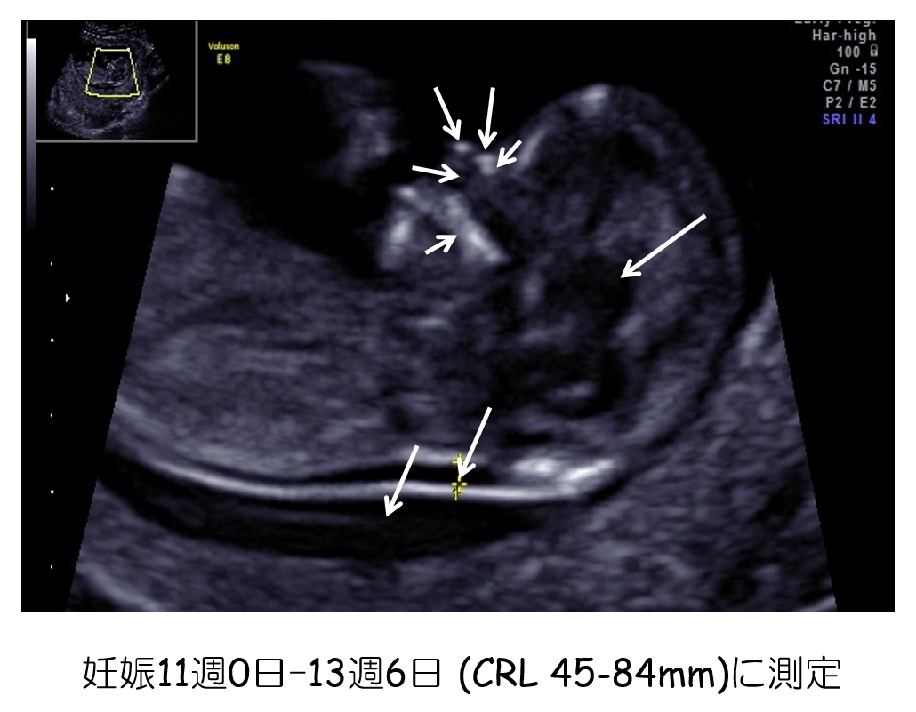 14 初期の超音波マーカー検査 日本産婦人科医会