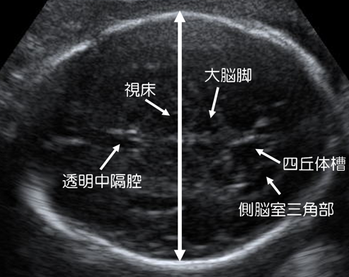 スクリーニング 検査 妊婦