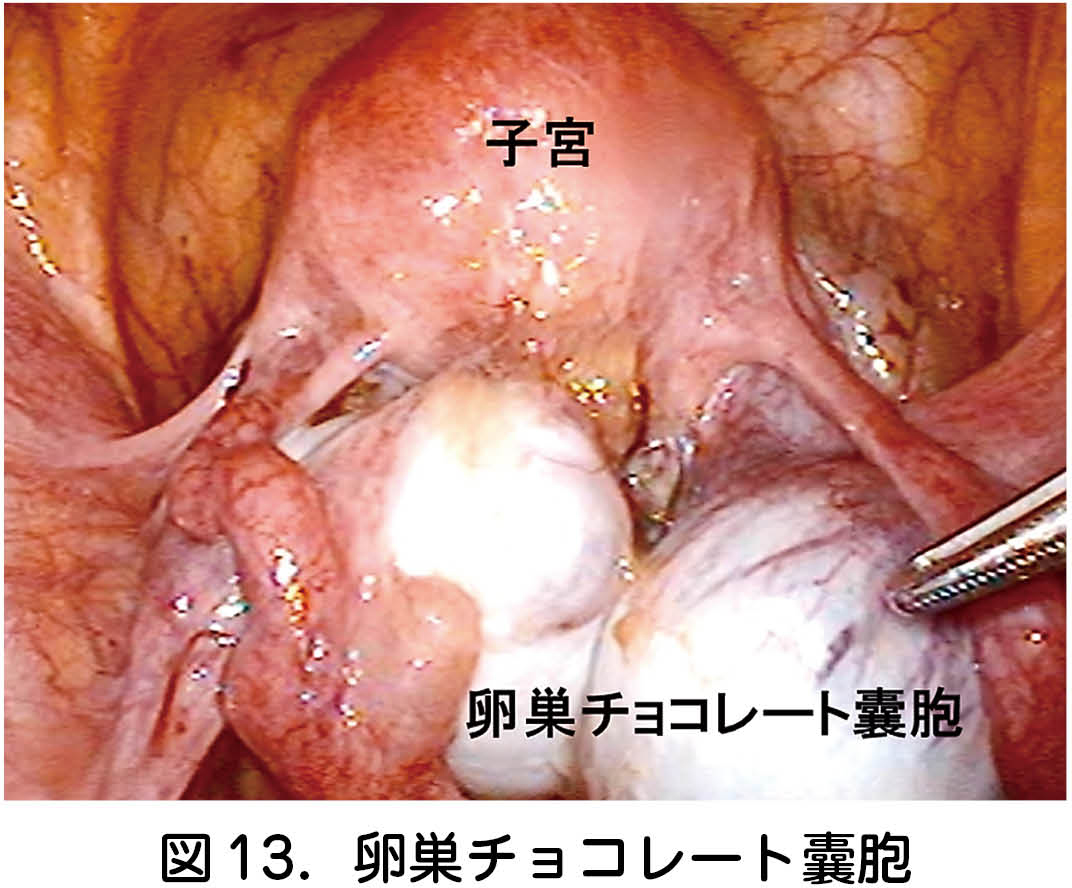 卵巣 嚢腫 再発