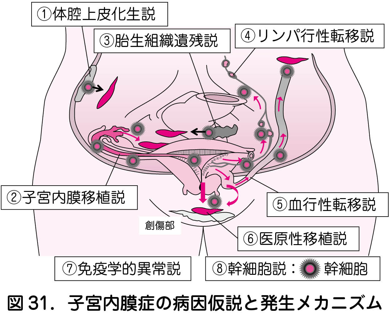 1 子宮内膜症の発生 日本産婦人科医会