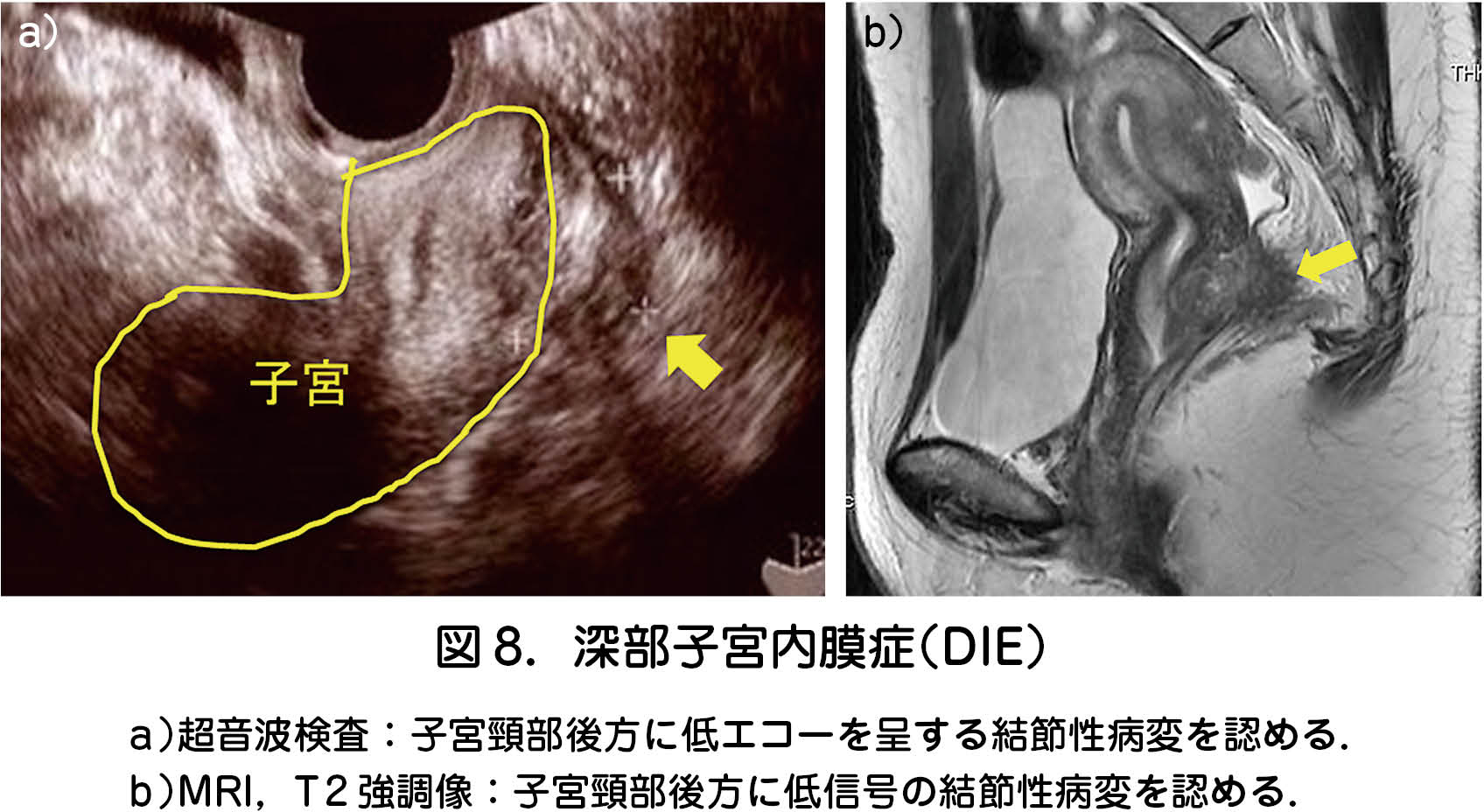 子宮 筋腫 mri 生理 中でも いい の