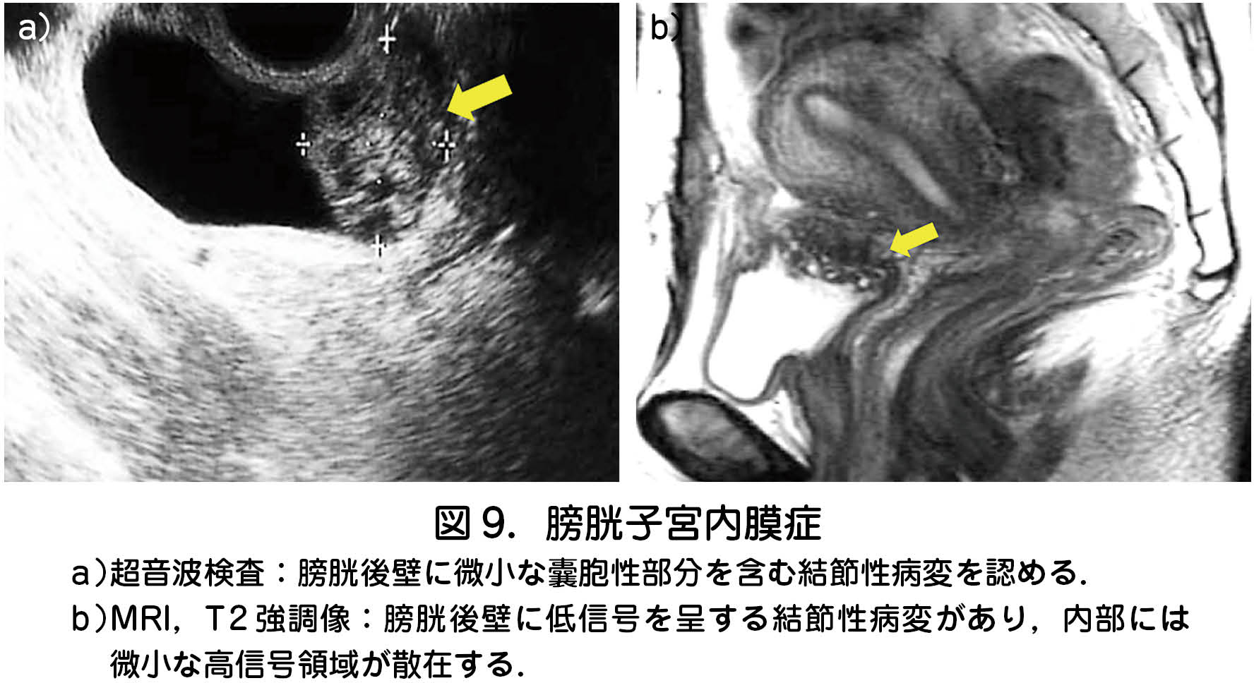 トップ Mri 画像 見方 卵巣 がじゃなたろう