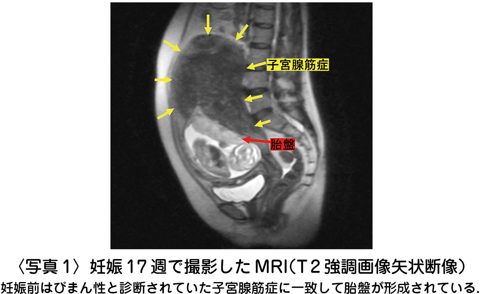 妊娠 中 子宮 筋腫