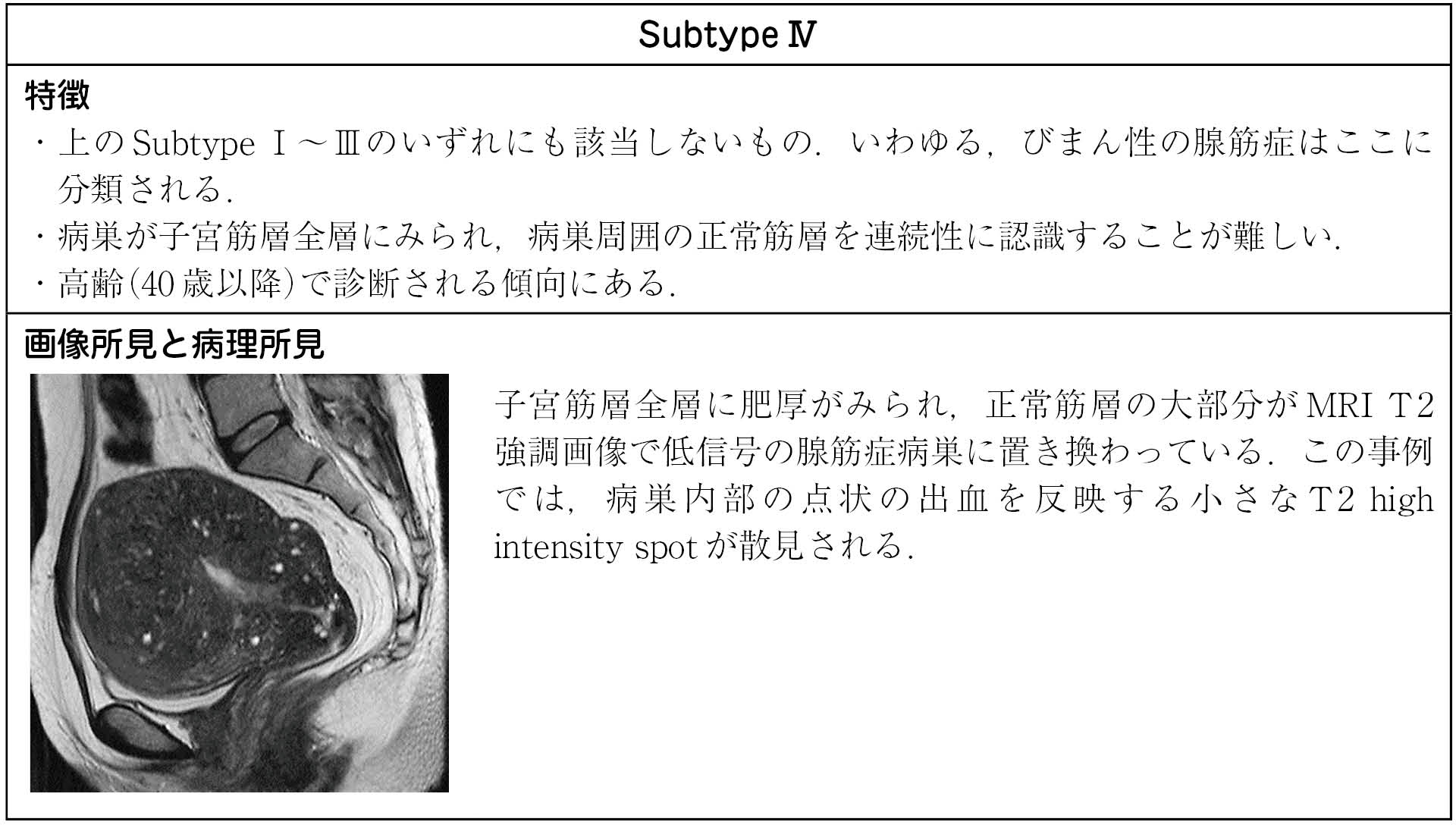 変性 子宮 筋腫