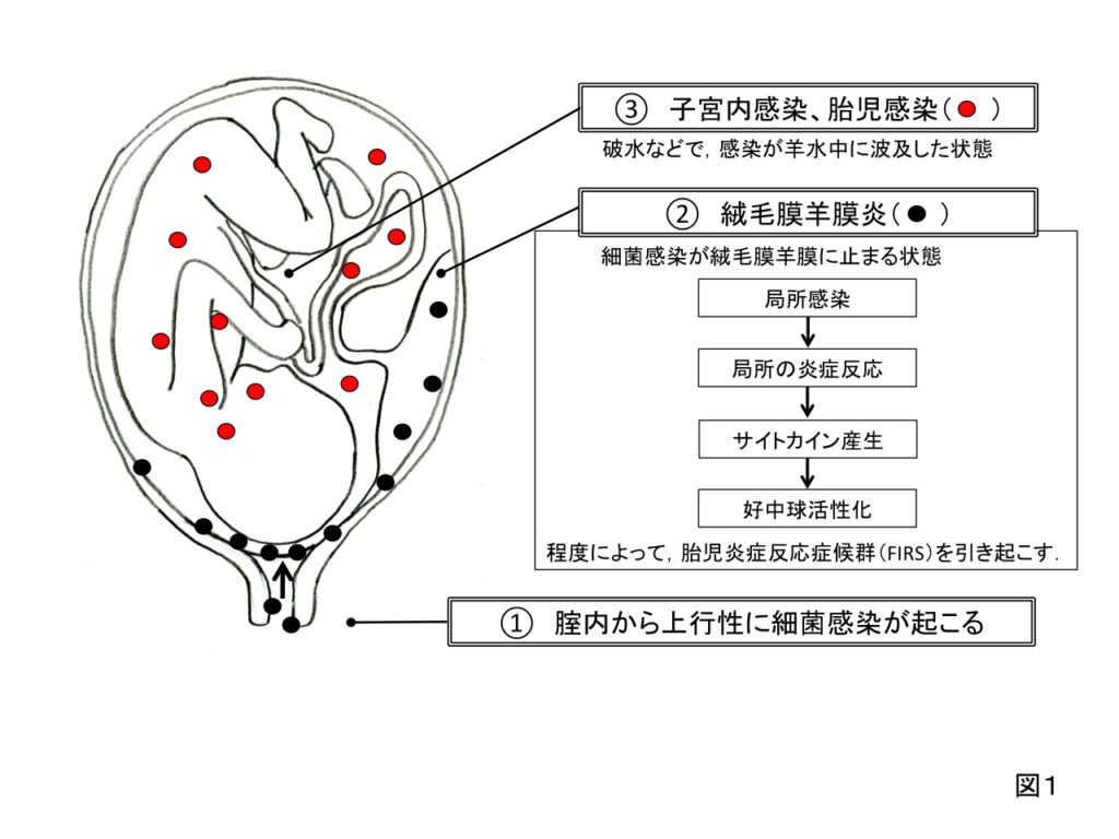 32 ジャンプアップ8 絨毛膜羊膜炎 子宮内感染症 日本産婦人科医会