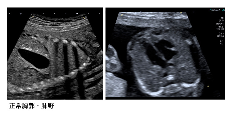胎児の形態異常 胸部 日本産婦人科医会