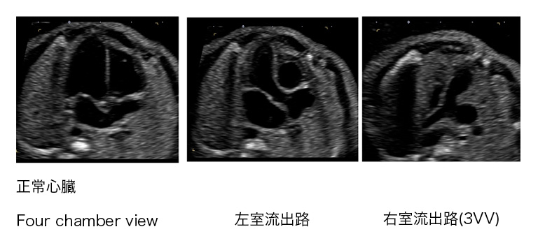 胎児 用 奇形 腫