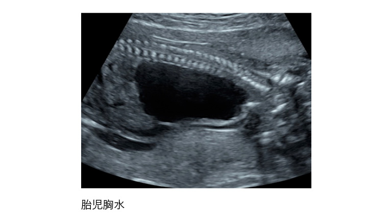 胎児の形態異常 胸部 日本産婦人科医会