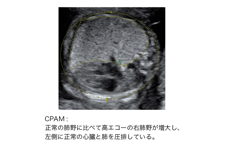 胎児の形態異常 胸部 日本産婦人科医会