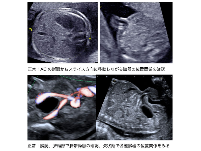 21 胎児の形態異常 腹部 日本産婦人科医会