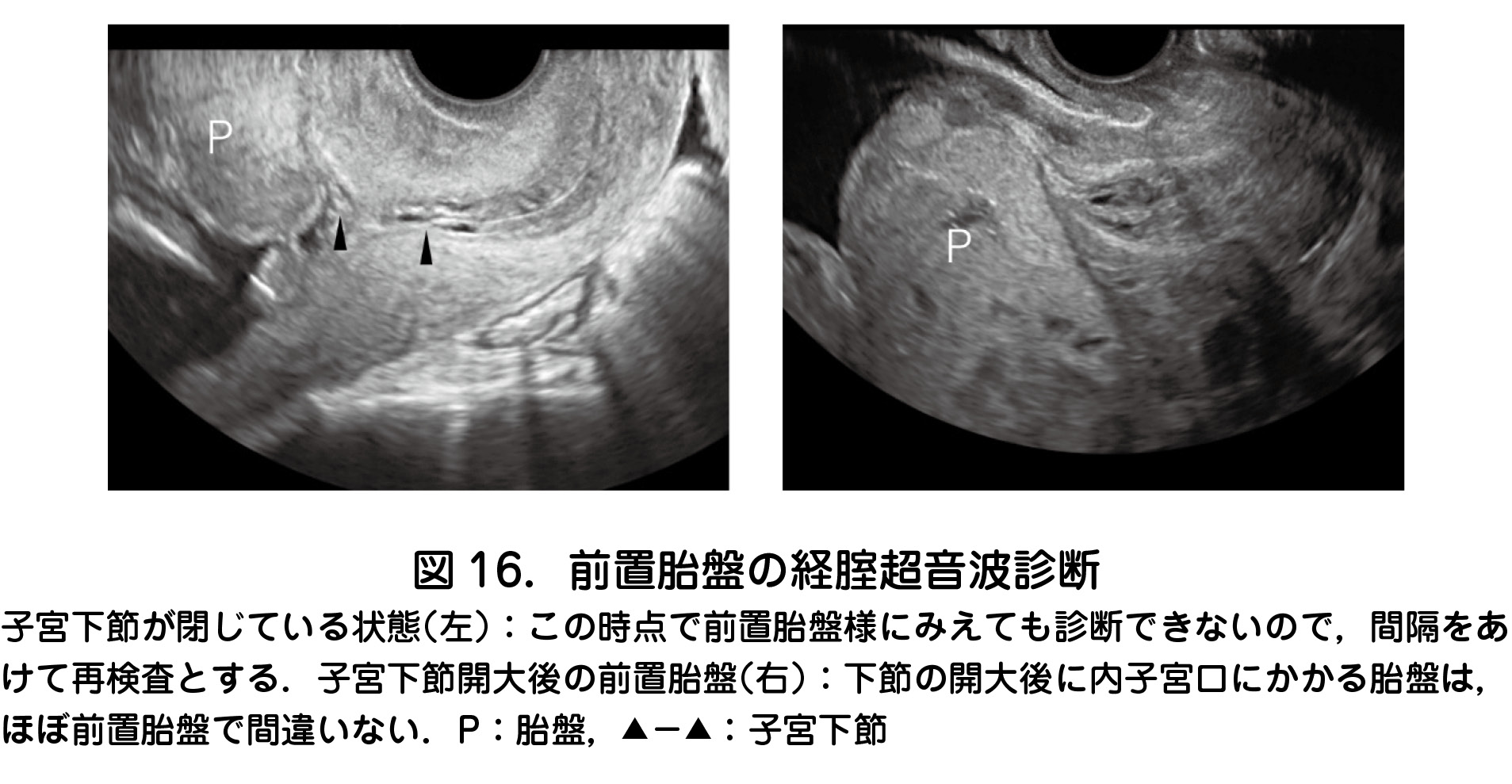 2 前置胎盤 癒着胎盤 日本産婦人科医会