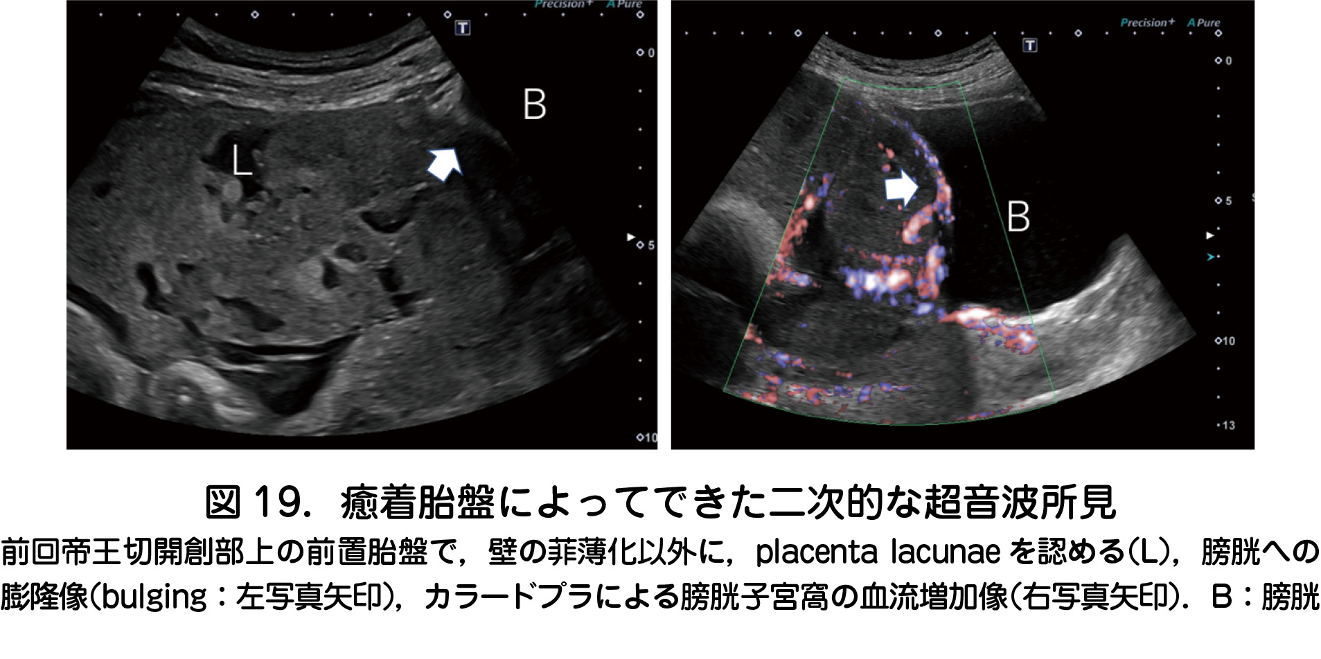 2 前置胎盤 癒着胎盤 日本産婦人科医会