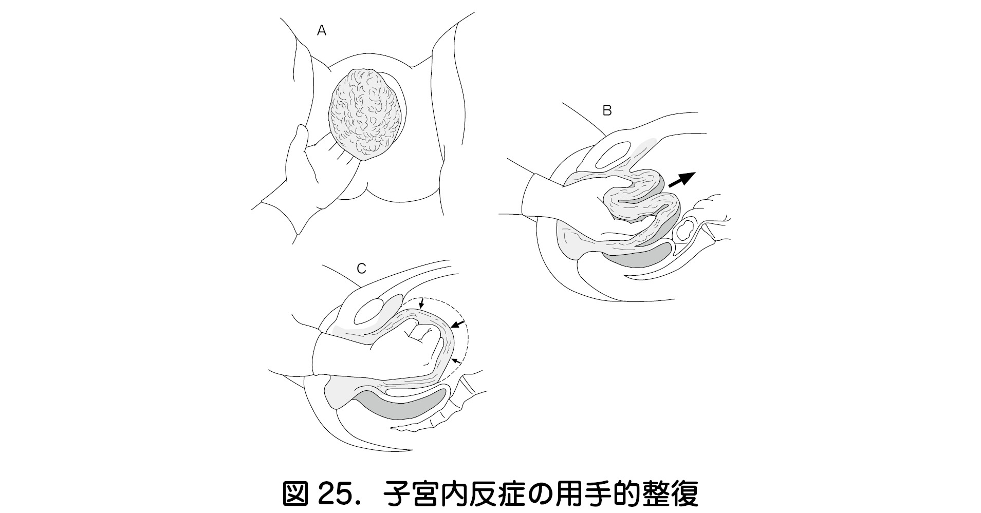 3 子宮内反症 Uterine Inversion 日本産婦人科医会