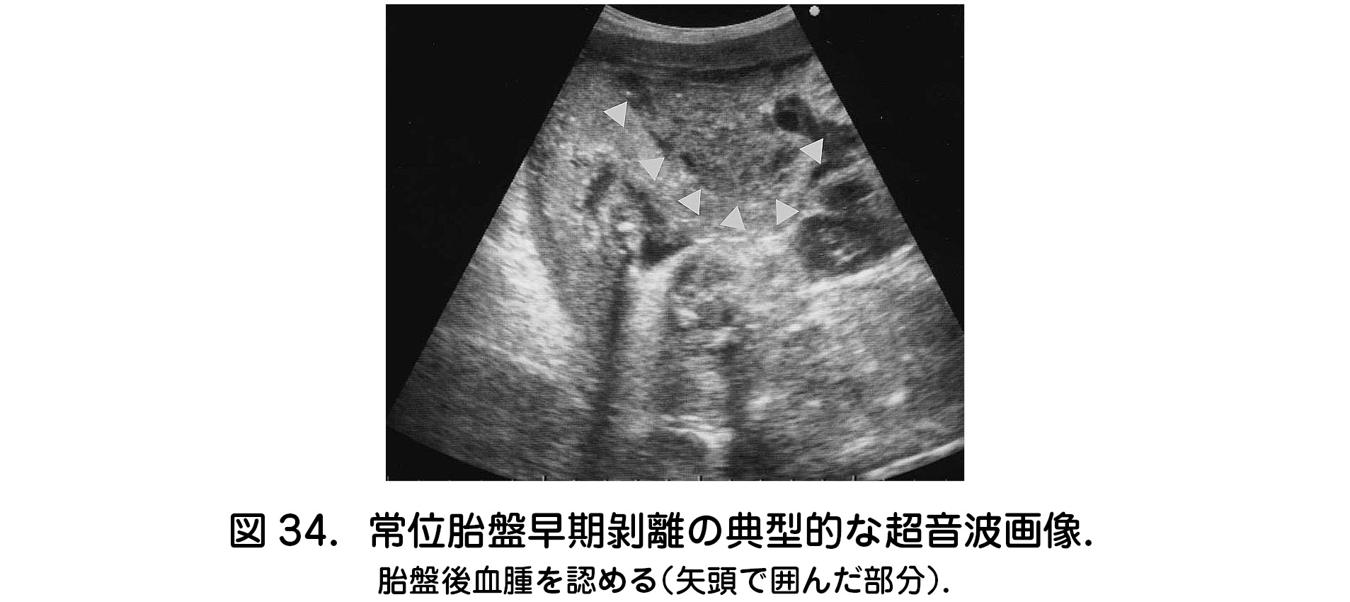 [最も選択された] 胎盤 画像 204684胎盤 mri 画像