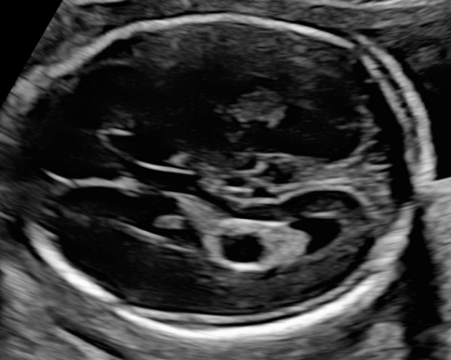 24 胎児の異常所見か悩む超音波所見 日本産婦人科医会
