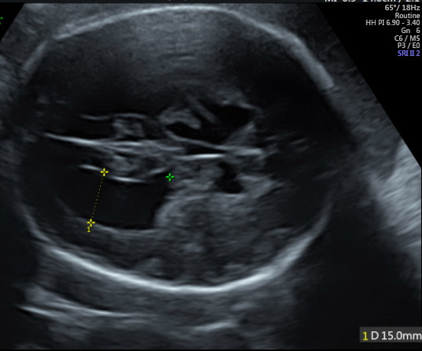 24 胎児の異常所見か悩む超音波所見 日本産婦人科医会