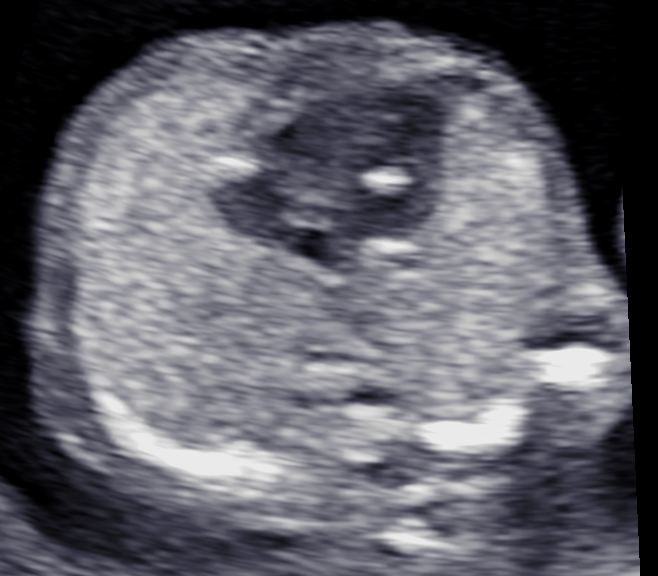 24. 胎児の異常所見か悩む超音波所見 – 日本産婦人科医会