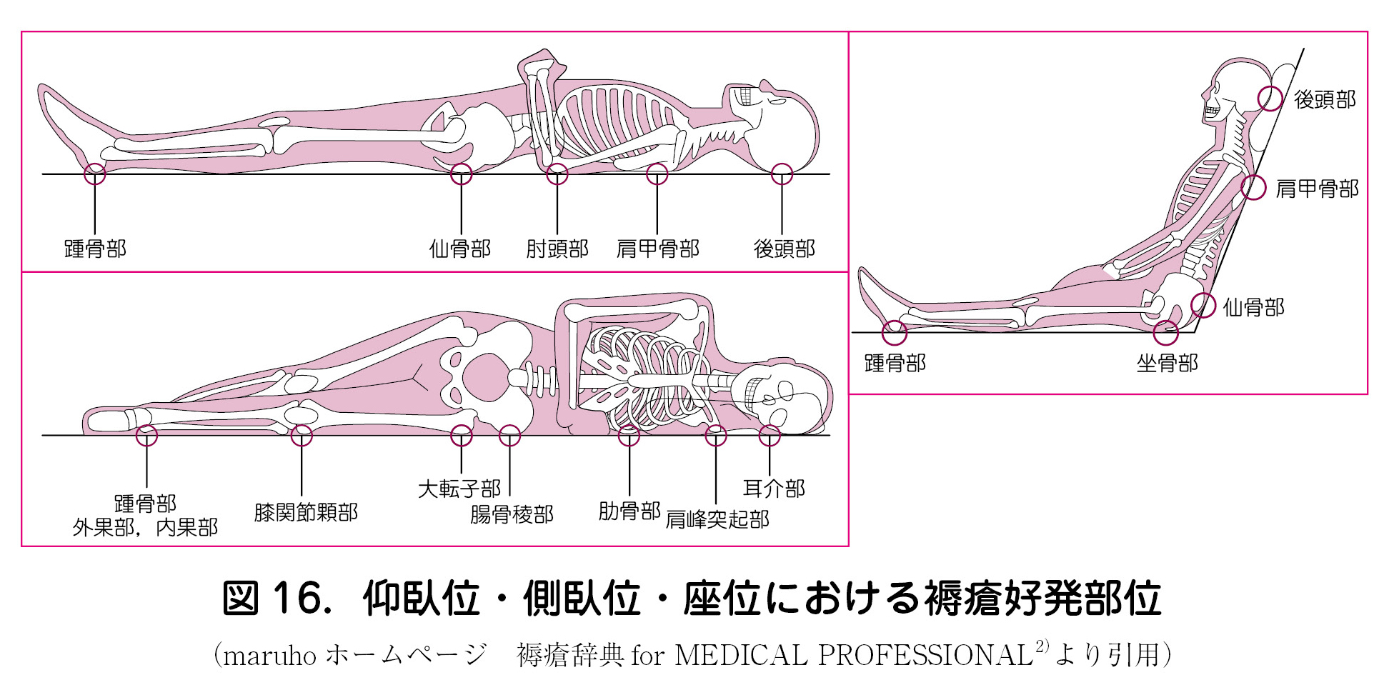 9 褥瘡の予防と管理 日本産婦人科医会