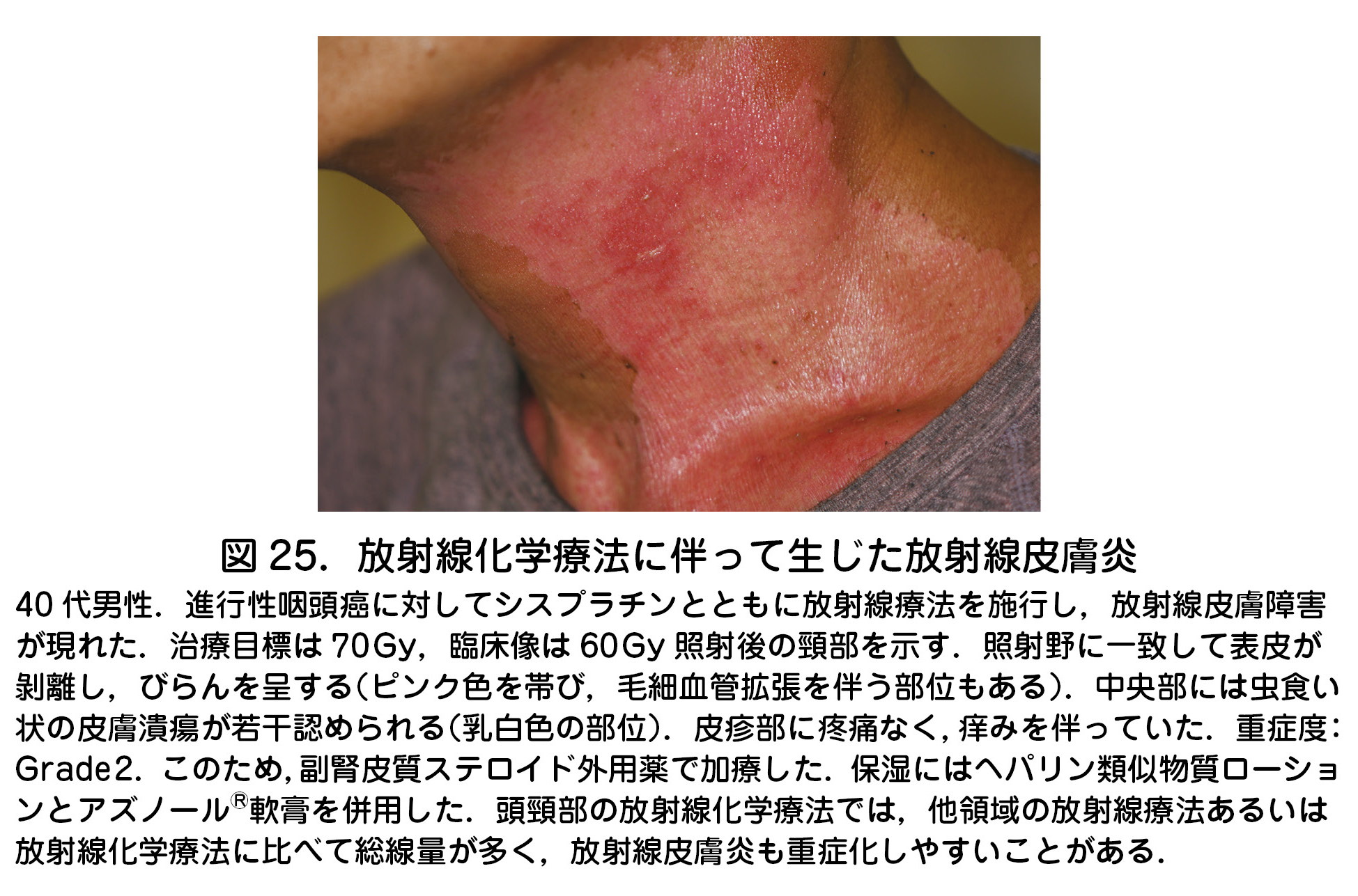 食道がんに対する放射線の副作用にはどのようなものがありますか?