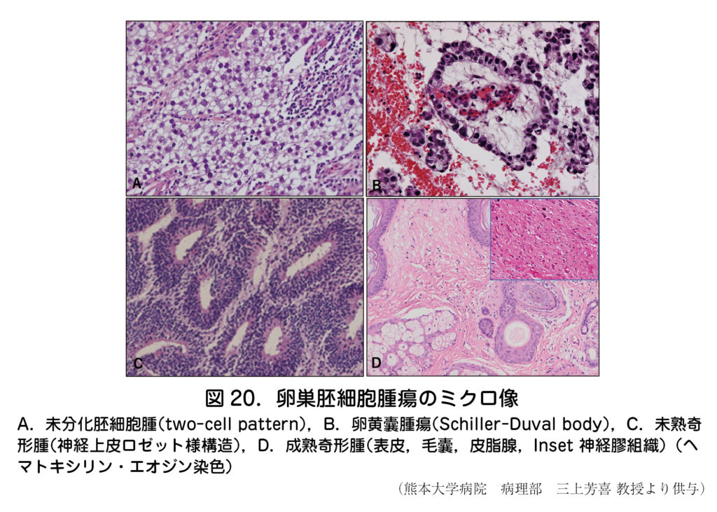 奇形 腫 卵巣