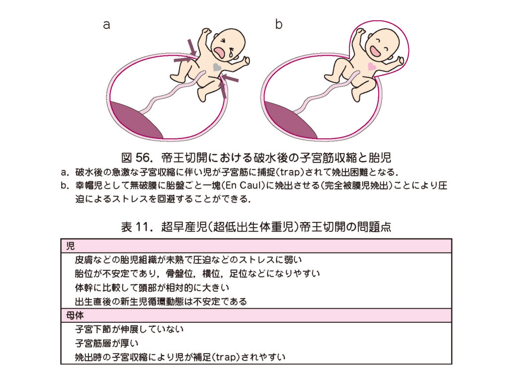 筋膜切開術に代わるものはありますか?