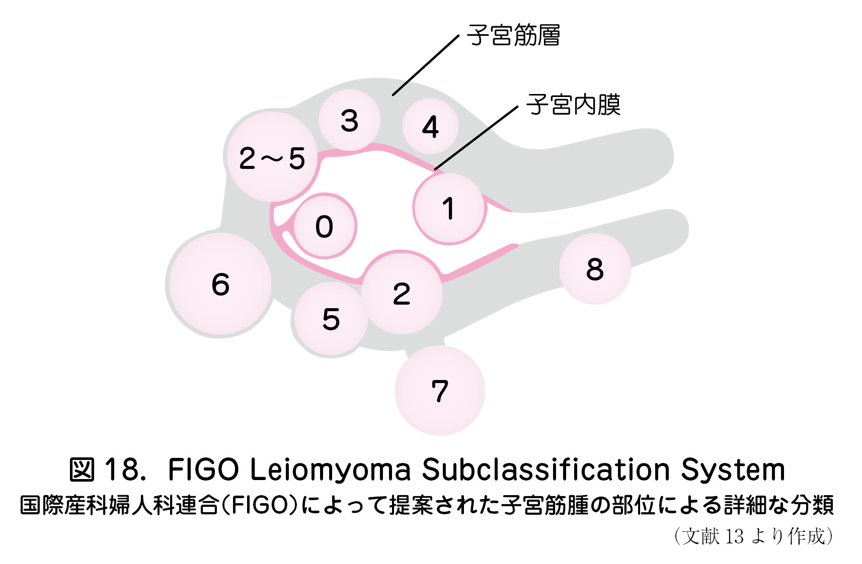 図18．FIGOLeiomyomaSubclassificationSystem