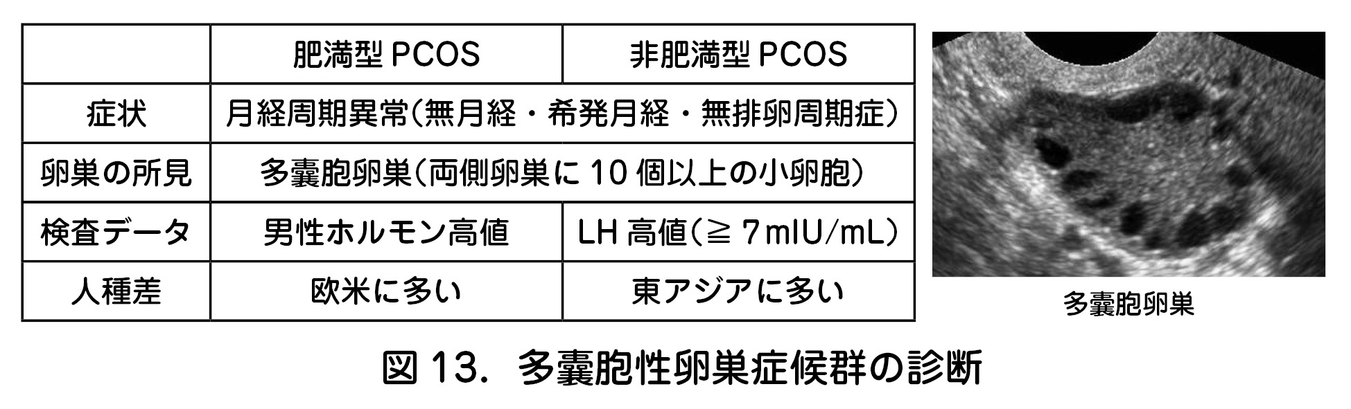 図13．多囊胞性卵巣症候群の診断