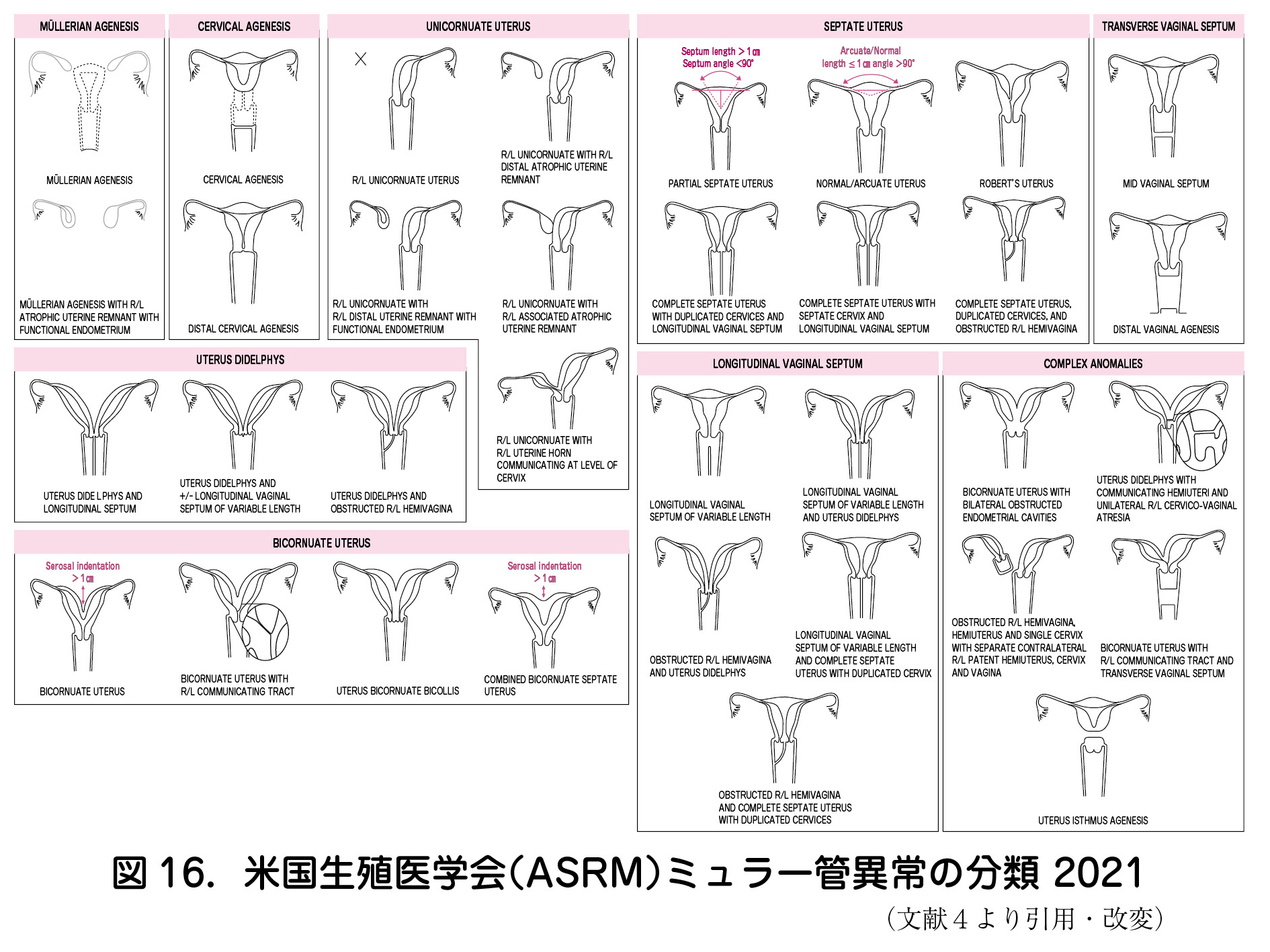 図16．米国生殖医学会（ASRM）ミュラー管異常の分類2021