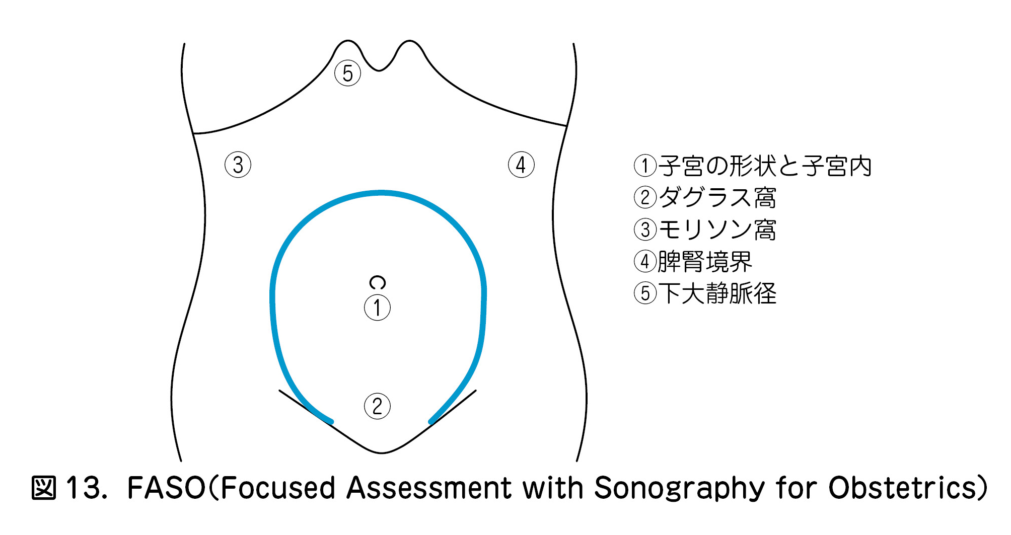 図13．FASO（Focused Assessment with Sonography for Obstetrics）